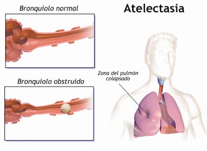 Qué es y de qué forma afecta la atelectasia