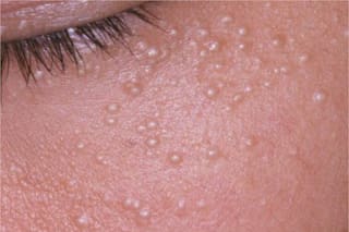 Qué son los quistes de millium: la infección que rodea los ojos y es confundida con el acné
