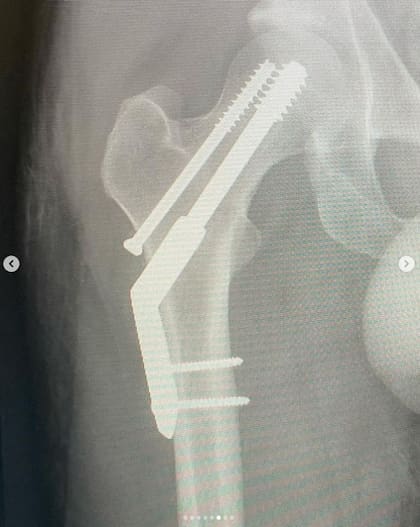 Radiografía de cómo quedó la pierna de Kevin Parker, luego de la cirugía a la que fue sometido el cantante del Tame Impala