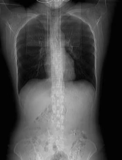 Radiografía que demuestra las cuatro costillas fracturadas de la ciudadana china