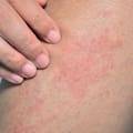 Qué es el sarpullido por calor y cómo es el tratamiento