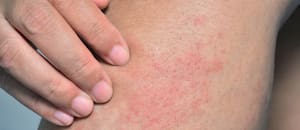Qué es el sarpullido por calor y cómo es el tratamiento