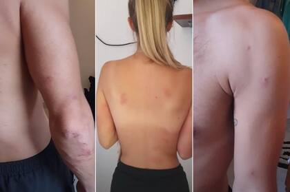 Leanne y Dan recibieron más de 30 picaduras cada uno de las abejas asesinas sin embargo no sufrieron mayores complicaciones