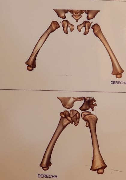 Reconstrucción 3D de la tomografía de Emma, en la que se observa el fémur sin secuelas visibles