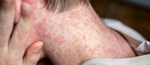 La familia que cruzó medio país con sarampión tuvo al menos 98 contactos estrechos e investigan otros 54