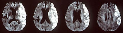 Resonancia magnética de un accidente cerebrovascular