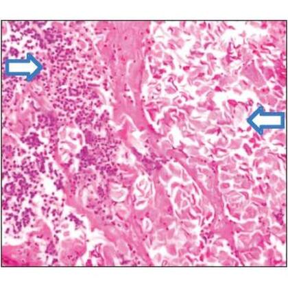 Resultados de una biopsia que muestran lesiones granulomatosas en los conductos auditivos externos del niño