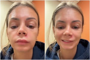 Reventarse un grano en el “triángulo de la muerte” puede provocar complicaciones graves, advirtió una especialista