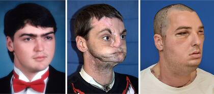 Richard Norris, antes y después del accidente y con los resultados del trasplante