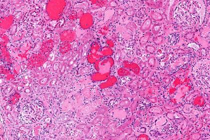 Riñón de un paciente con síndrome urémico hemolítico por E. coli