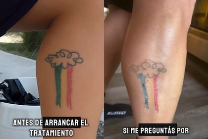 Santiago Maratea mostró cómo está su tatuaje tras comenzar el procedimiento para borrarlo; hasta la fecha se realizó dos sesiones (Foto: Captura de video / Instagram @santimaratea)
