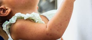 “El sarampión se llevó a mi hija; los padres necesitan saber lo peligroso que es”