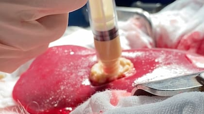 Se estima que el gel hemostático Traumagel será lanzado antes de fines de 2024 y podría prevenir muertes por esta causa