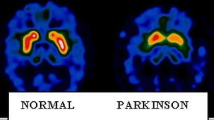 Se han descubierto alteraciones genéticas que favorecen el desarrollo del Parkinson