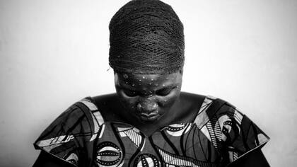 Se han reportado casos de la enfermedad por años en África