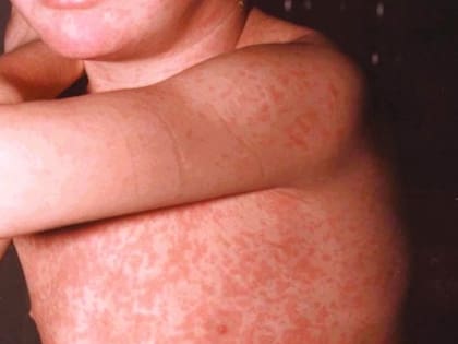 Se investiga si tiene relación con los viajeros uruguayos el caso de un menor de 2 años de Entre Ríos, cuya familia había viajado a Santa Fe en fechas coincidentes