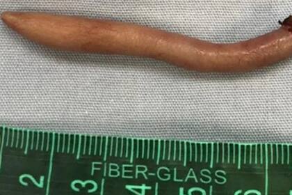 Se registra el nacimiento de una bebé con cola en Nuevo León