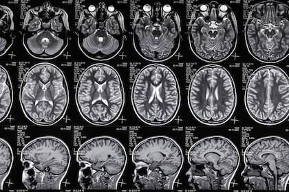 Se trata de una investigación en curso en colaboración con Fleni, que es quien aporta las resonancias magnéticas con las que se le está enseñando a la IA.
