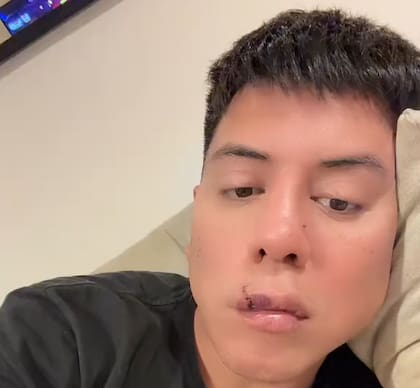 Según contó, la lesión le generó complicaciones laborales (Foto: @marianodelacanal)