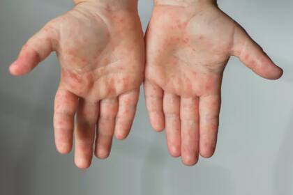 Según datos del año 2020, la confianza en la importancia y la seguridad de la vacuna contra el sarampión aumentó notablemente en un gran número de países