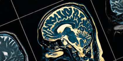 Según investigaciones, esto se debe a que algunas partes del cerebro son más grandes de lo usual