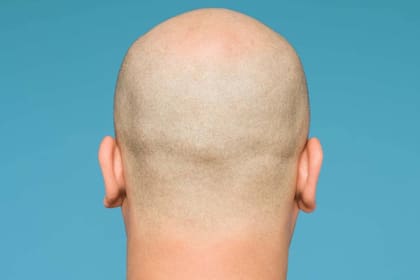 El término alopecia refiere a cualquier forma de pérdida de cabello y puede tener muchas causas