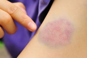 Señales de deficiencias nutricionales.