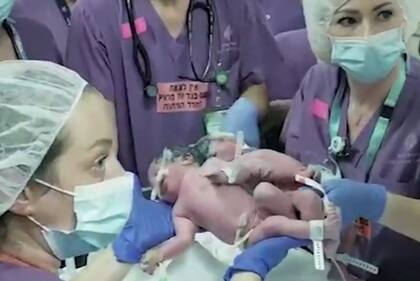 Siamesas que estaban unidas por la cabeza fueron operadas y se vieron por primera vez tras la operación