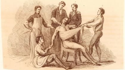 Sin anestesia, había que sujetar a los pacientes mientras los sometían a un dolor agonizante