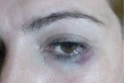 Soledad, la mujer que denunció a los rugbiers franceses Hugo Auradou y Oscar Jegou, dio a conocer algunas fotos de las marcas en su cuerpo tras las agresiones