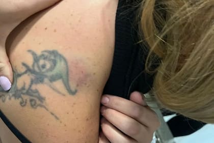 Soledad, la mujer que denunció a los rugbiers franceses Hugo Auradou y Oscar Jegou, dio a conocer algunas fotos de las marcas en su cuerpo tras las agresiones