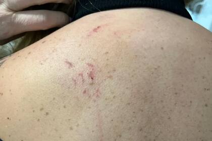 Soledad, la mujer que denunció a los rugbiers franceses Hugo Auradou y Oscar Jegou, dio a conocer algunas fotos de las marcas en su cuerpo tras las agresiones