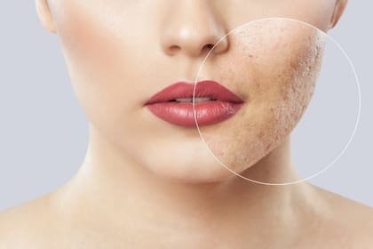 El acné avanza cuando hay células muertas en la superficie de la piel