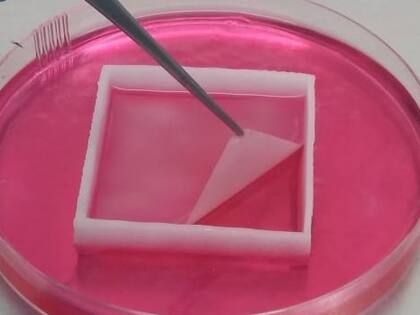 Sustituto cutáneo "listo para usar" que elabora el Grupo de Terapias Avanzadas de Cassará para curar úlceras crónicas profundas; procesan células dérmicas y epidérmicas de una pequeña muestra de piel del paciente y eso evita el rechazo del neotejido