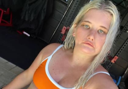 Tayla Clements sufre de una rara enfermedad congénita llamada síndrome de Moebius