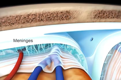 La meningitis bacteriana es la inflamación de las cuatro membranas que recubren el cerebro y la médula espinal, como consecuencia de la presencia de virus o bacterias