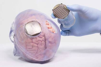 Thibault se sometió a una cirugía para colocar dos implantes en la superficie de su cerebro, cubriendo las partes que controlan el movimiento