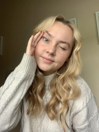 Tia-Leigh Streamer de 22 años tiene que pegar sus ojos con una cinta adhesiva o pegamento para mantener los párpados arriba