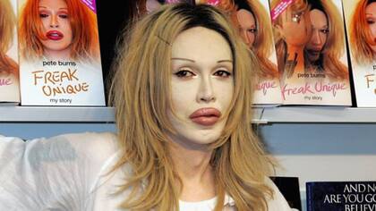 Todos estamos acostumbrados a ver los resultados positivos o negativos de las aplicaciones de toxina botulínica