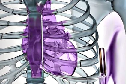 Todos los estudios sobre “infartos silenciosos” han confirmado que las personas con estas imágenes tienen hasta 5 veces más probabilidades de tener una ACV, infarto cardíaco, demencia y otras enfermedades cardiovasculares