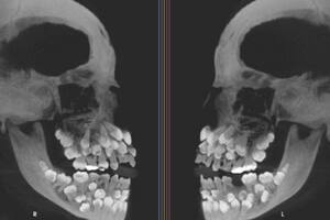 El extraño caso de una niña que nació con 81 dientes y se volvió un “reto clínico” para los odontólogos
