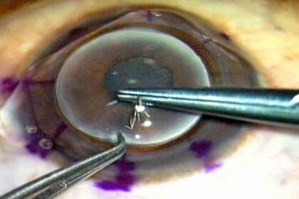 Tránsplante de córnea