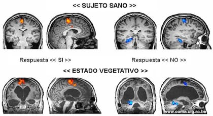 Tras detectar señales de conciencia, los médicos escanearon el cerebro del hombre mientras le pedían que dijera "sí" o "no" a distintas preguntas
