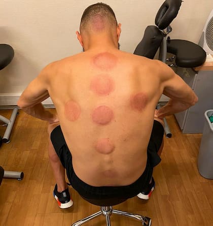 Tras una sesión de ventosas, Benzema exhibe sus "marcas" por las redes sociales