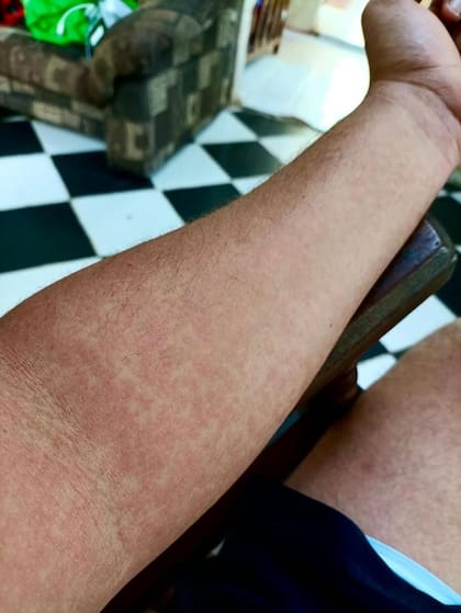 Tras varios días de dolores y fiebre, a Hansel le salió un sarpullido en todo el cuerpo.