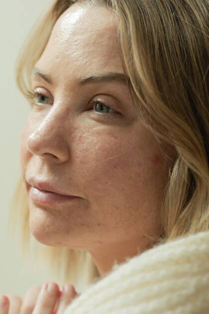 Redzikowski no ha dejado de rascarse, y duda que alguna vez lo haga del todo. A menudo se recuerda a sí misma: “Esto es un trastorno, no una elección”