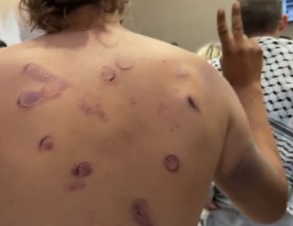 Un activista de la flotilla muestra marcas tras su detención por la Armada israelí