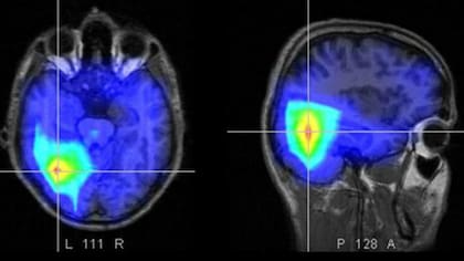El consumo de marihuana está asociado a un mayor riesgo sufrir un ACV, incluso entre los jóvenes