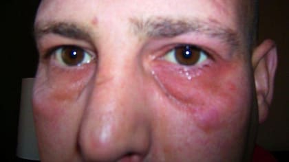 Un ataque comienza con el ojo izquierdo de Daren lloroso y caído