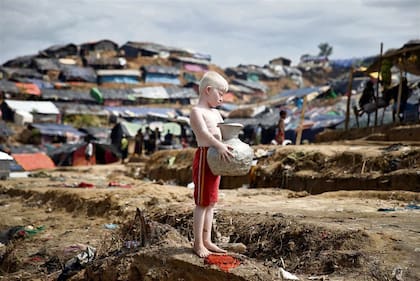 Un chico albino rohingya, refugiado en Bangladesh